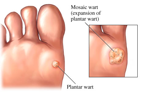 Plantar wart on the sole
